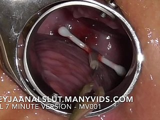 Amateur FreyjaAnalslut : Removing her IUD - pulling it out of Freyja's Cervix, making her fertile again - Full version on ManyVids